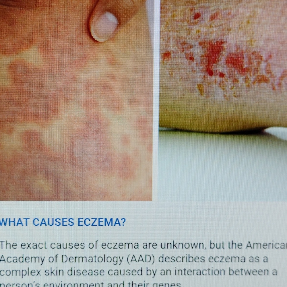 Renew Eczema Relief COLLOIDAL OATMEAL, USP-GRADE PETROLATUM PLANT-BASED GLYCERIN - Picture 6 of 16